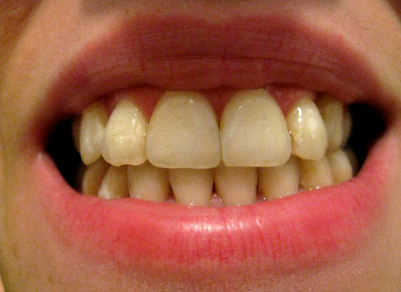After Treatment