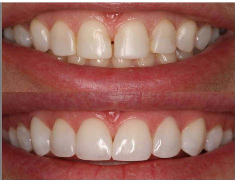 Before Treatment