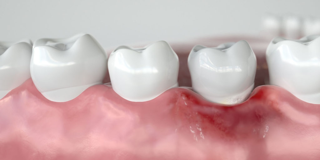 Gum Disease Treatment